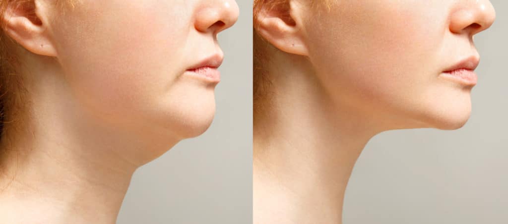 Before And After Fat Dissolve Injections | Euro Look Medical Spa in Solon, Ohio