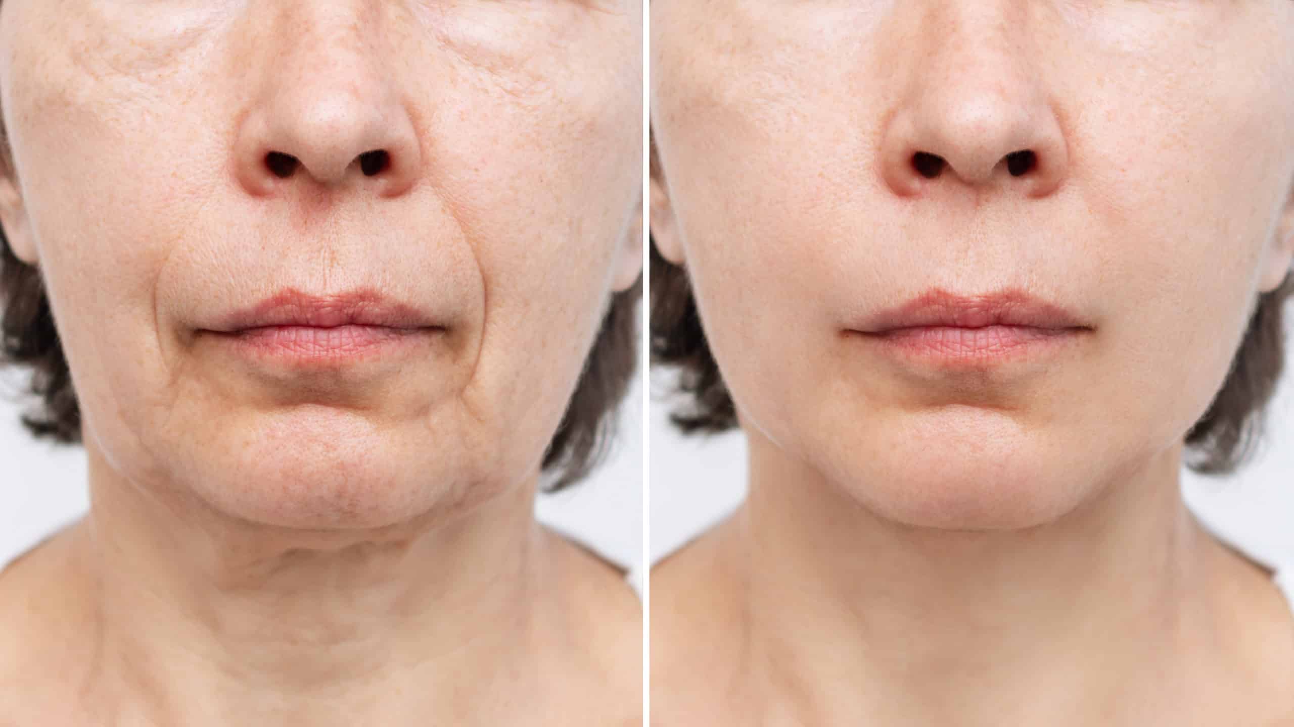 Before and After Hyperdilute Radiesse | Euro Look Medical Spa in Solon, Ohio