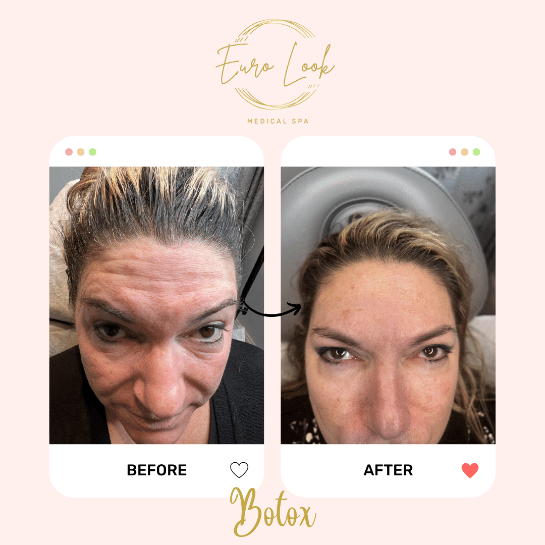 Before and After Botox treatment at Euro Look Medical Spa in Solon, Ohio