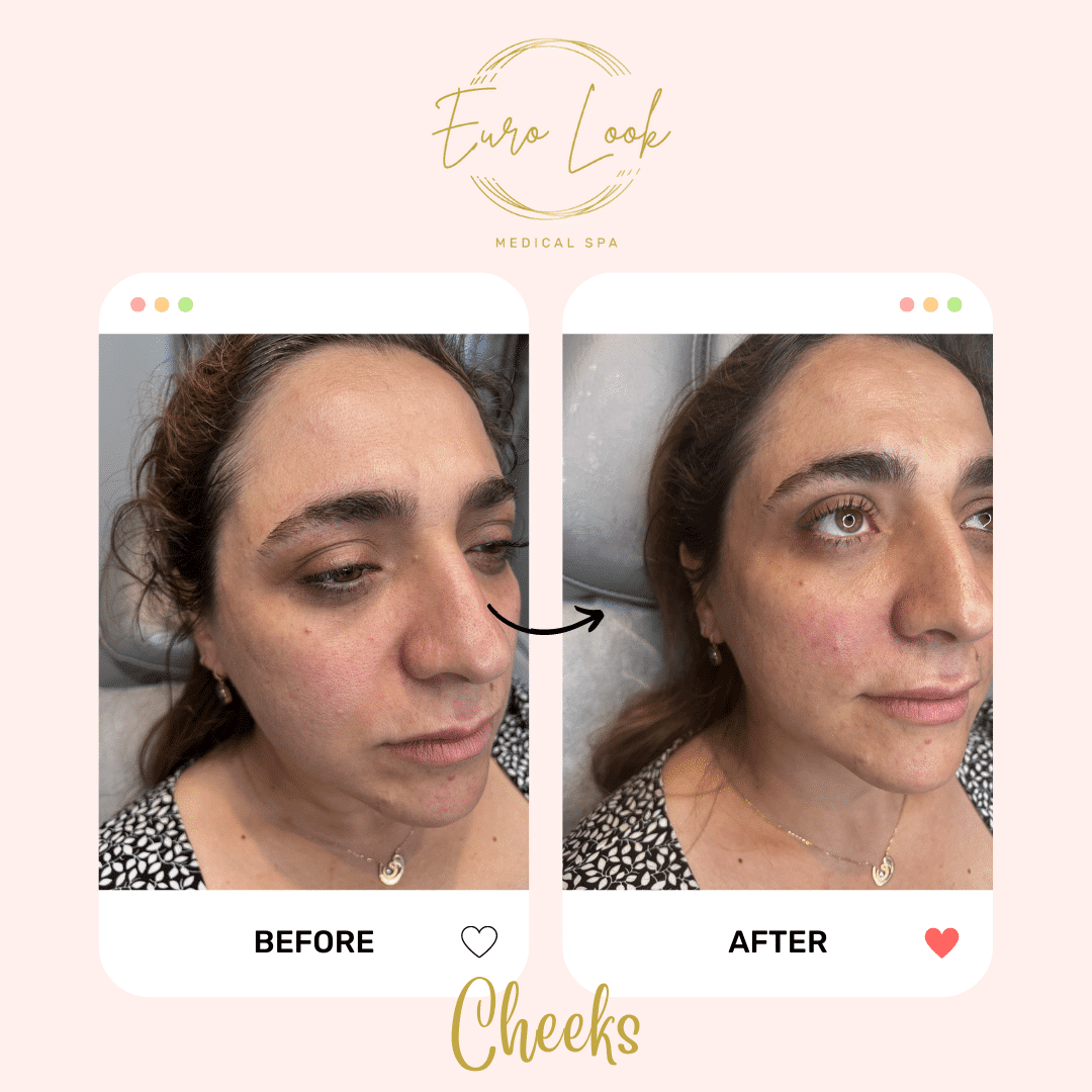 Before and After Cheeks treatment at Euro Look Medical Spa in Solon, Ohio