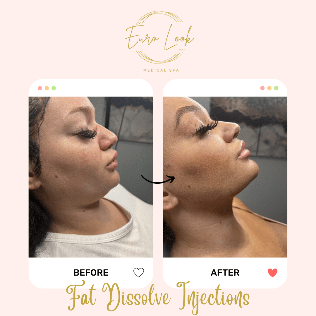 Before and After Fat Dissolve Injections treatment at Euro Look Medical Spa in Solon, Ohio