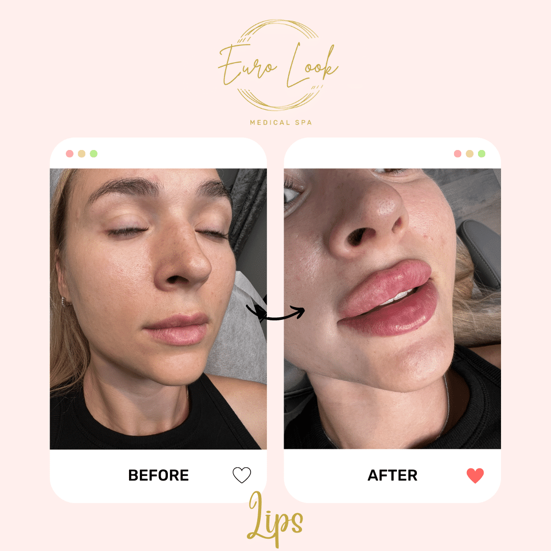 Before and After Lips treatment at Euro Look Medical Spa in Solon, Ohio