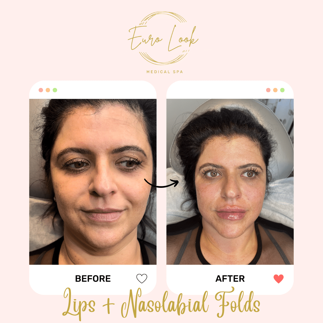 Before and After Lips + Nasolabial Folds treatment at Euro Look Medical Spa in Solon, Ohio