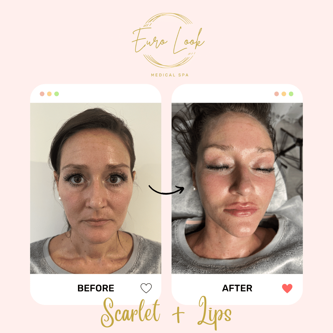Before and After Scarlet + Lips treatment at Euro Look Medical Spa in Solon, Ohio