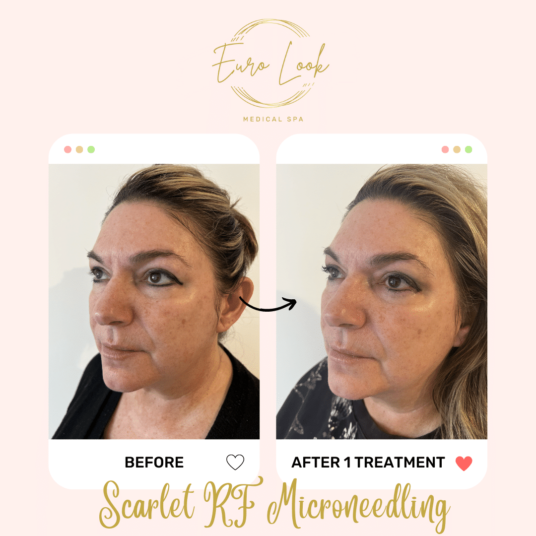 Before and After Scarlet RF Microneedling treatment at Euro Look Medical Spa in Solon, Ohio
