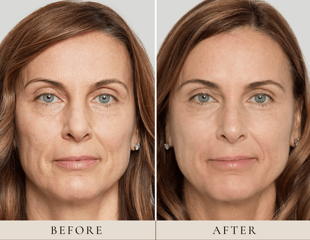 Before And After Sculptra Treatment | Euro Look Medical Spa in Solon, Ohio