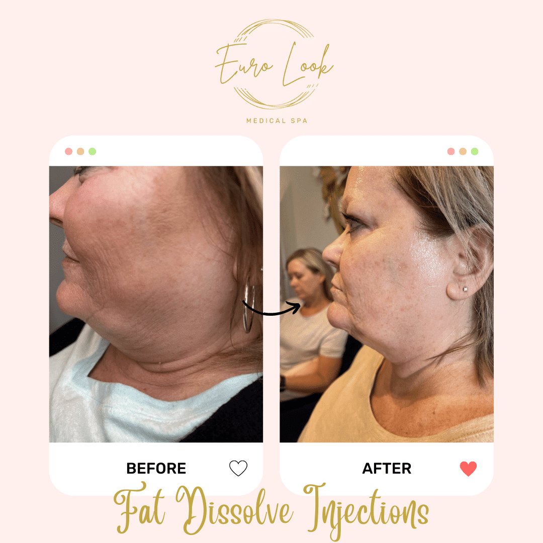 Before and After Fat Dissolve Injections treatment at Euro Look Medical Spa in Solon, Ohio