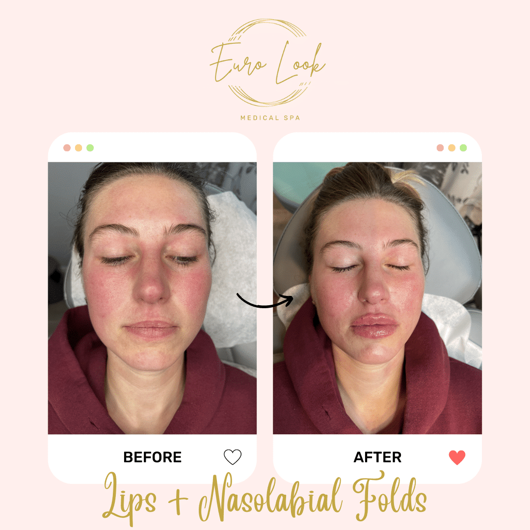 Before and After Lips + Nasolabial Folds treatment at Euro Look Medical Spa in Solon, Ohio
