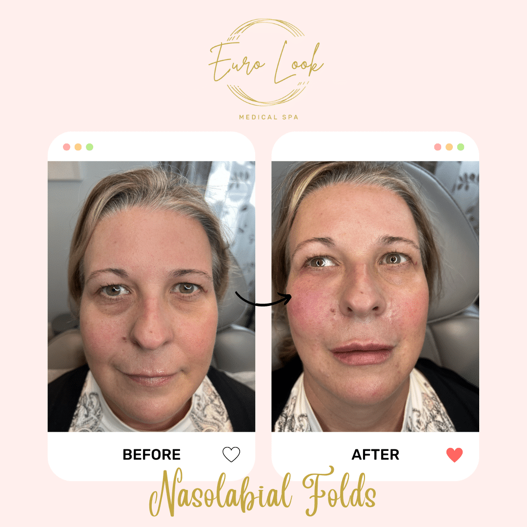 Before and After Nasolabial Folds treatment at Euro Look Medical Spa in Solon, Ohio