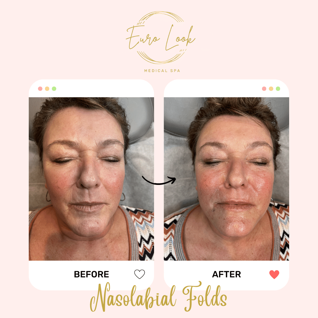 Before and After Nasolabial Folds treatment at Euro Look Medical Spa in Solon, Ohio