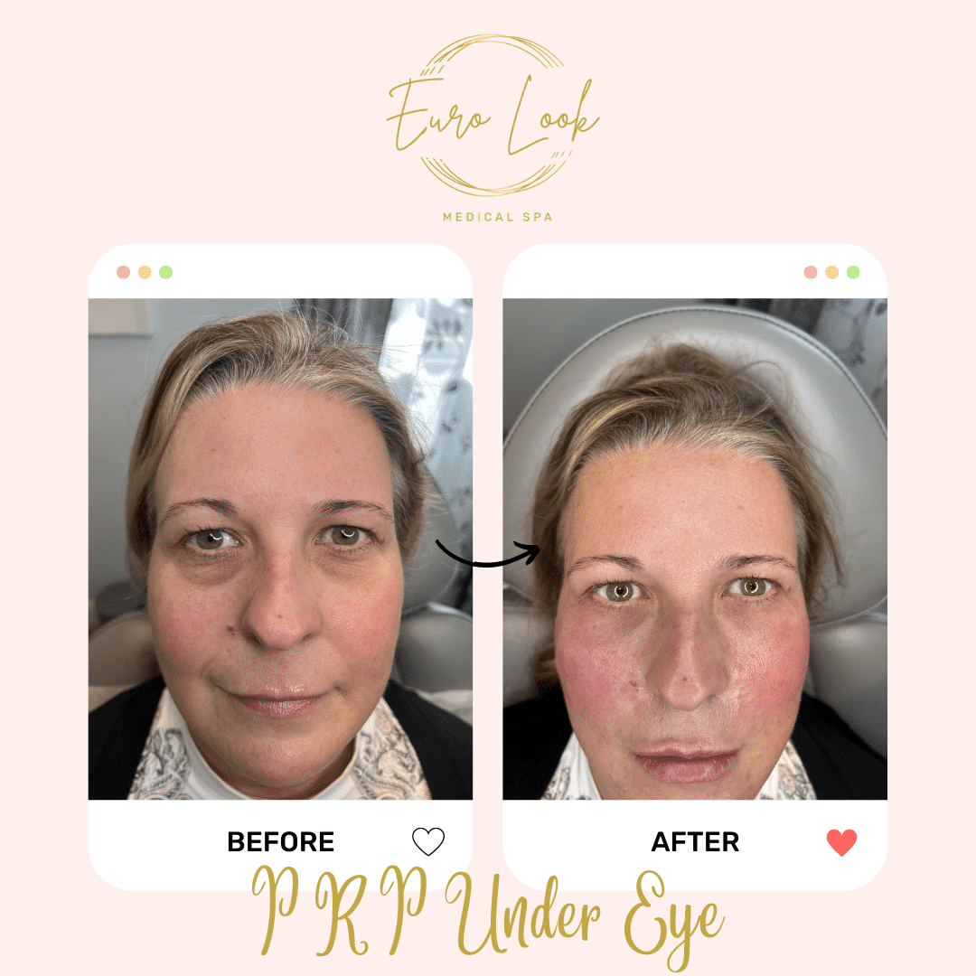 Before and After PRP Under Eye treatment at Euro Look Medical Spa in Solon, Ohio