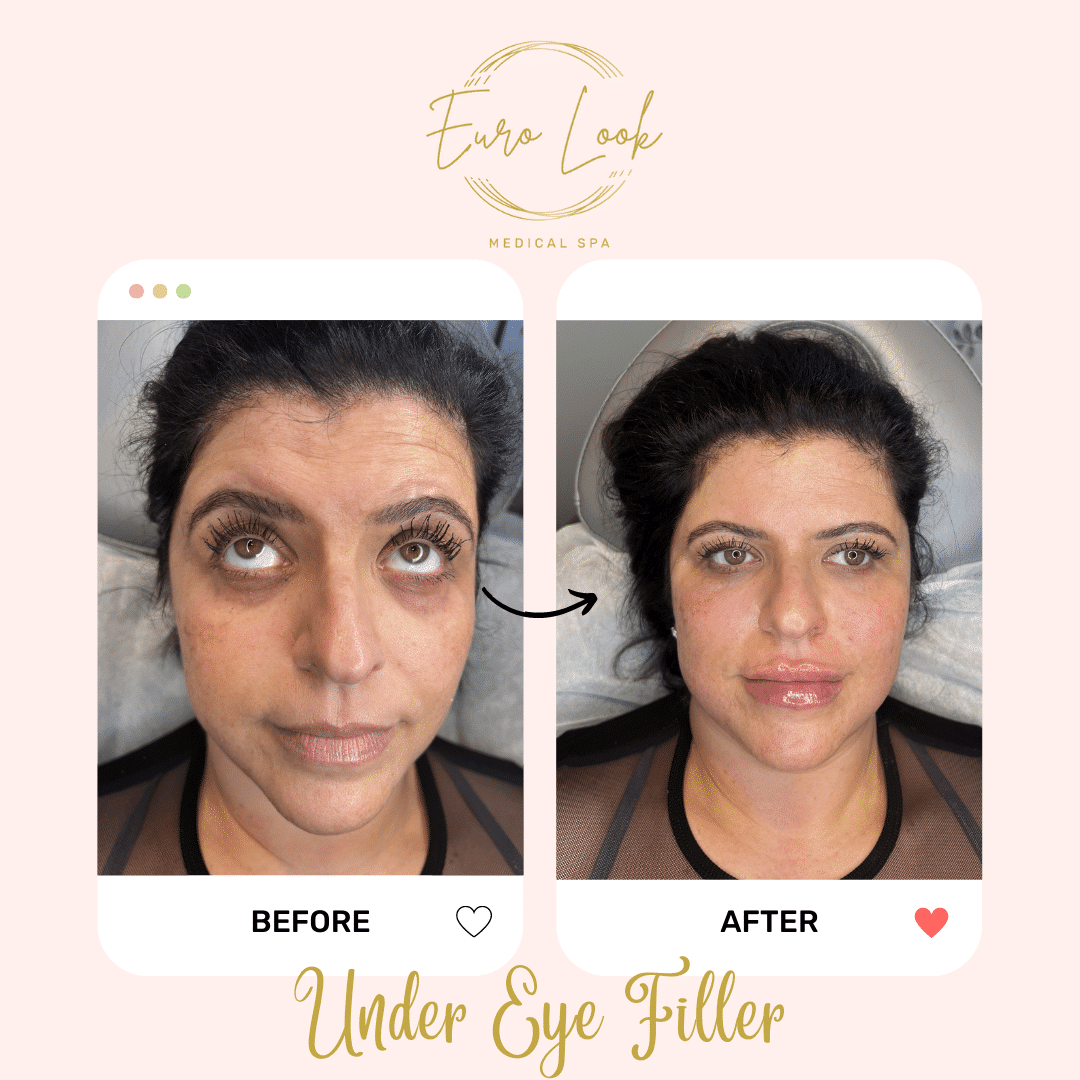 Before and After Under Eye Filler treatment at Euro Look Medical Spa in Solon, Ohio