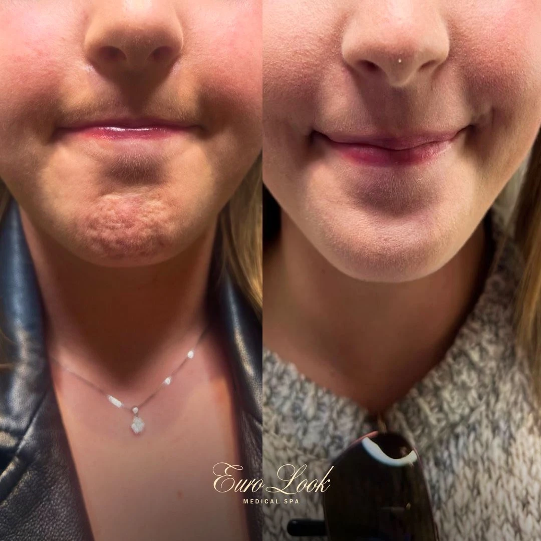 Neuromodulators Chin Dimple Before and After Results | Euro Look MedSpa