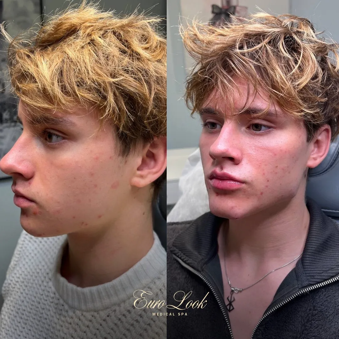 Chin Filler Before and After Results | Euro Look MedSpa