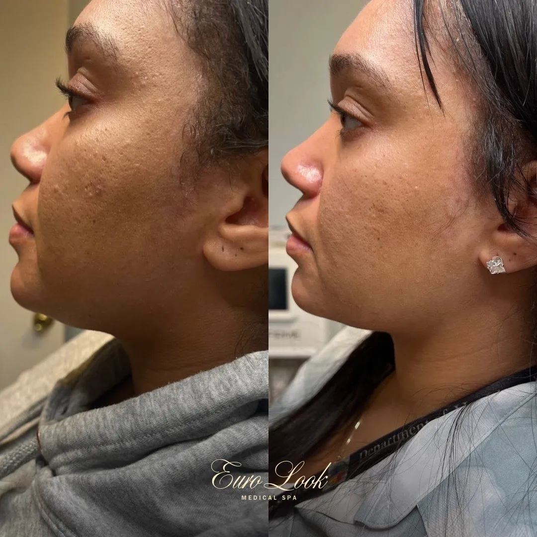 LIPO Dissolve Before and After Results | Euro Look MedSpa
