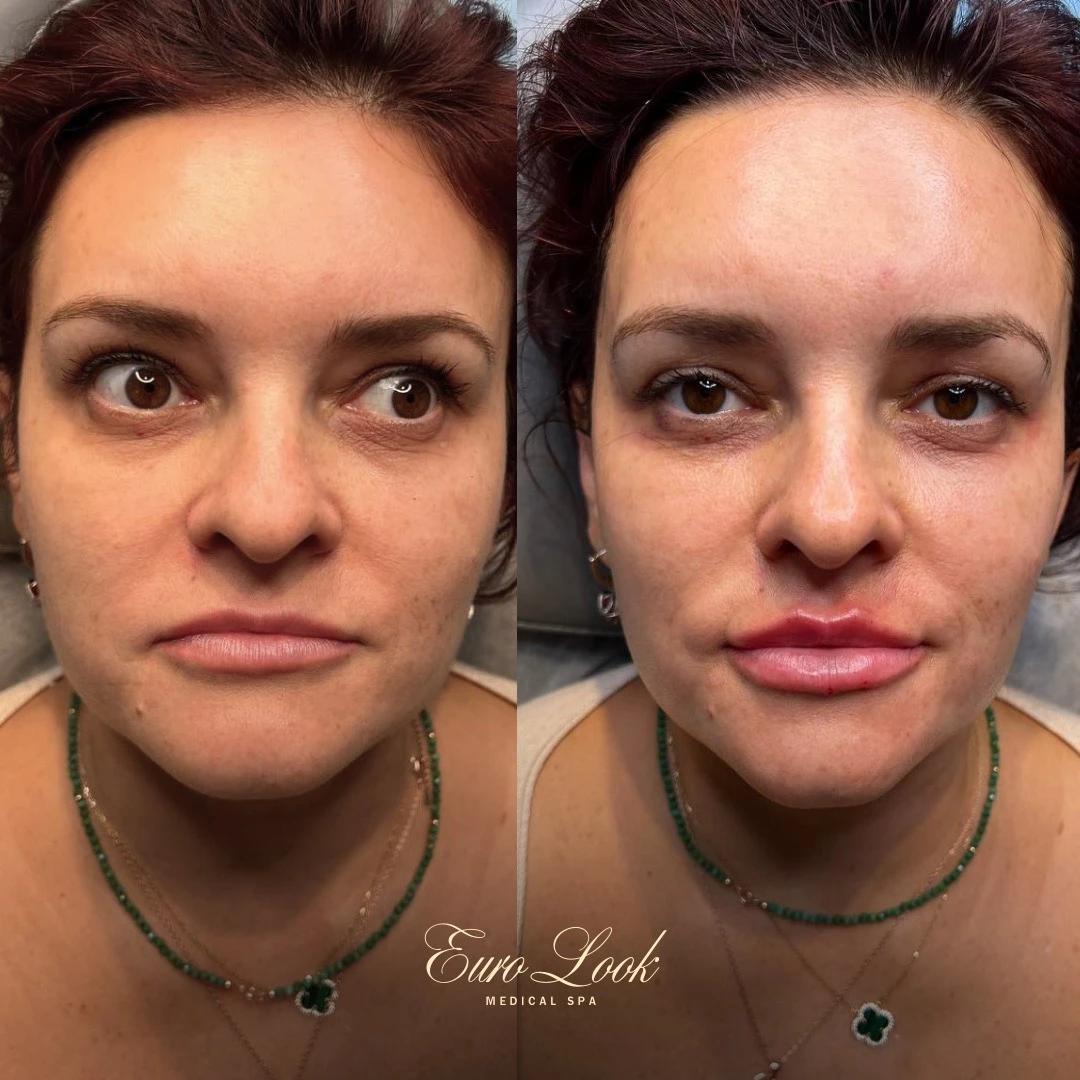 Lip Filler Before and After Results | Euro Look MedSpa