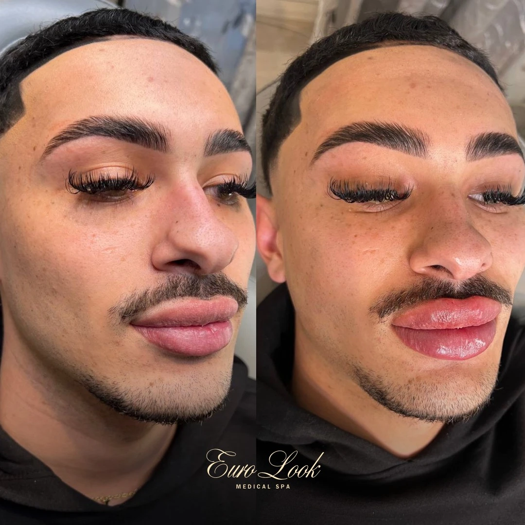 Lip Filler Before and After Results | Euro Look MedSpa