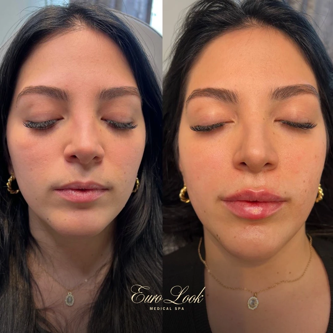 Lip Filler Before and After Results | Euro Look MedSpa
