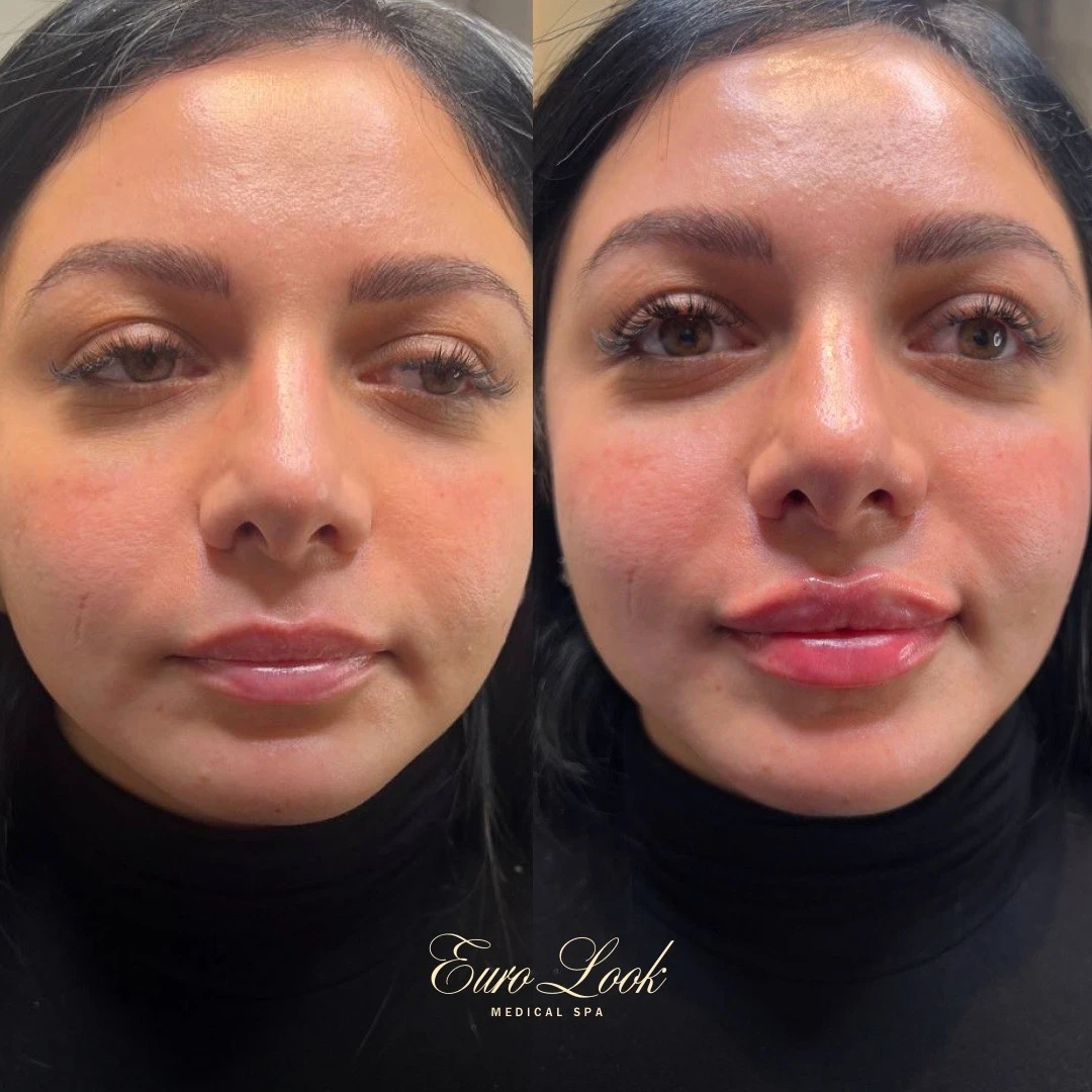 Lip Filler Before and After Results | Euro Look MedSpa