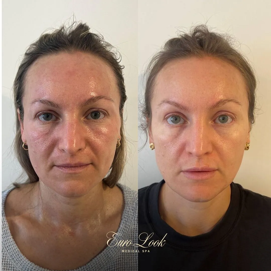 Scarlet RF Microneedling Before and After Results | Euro Look MedSpa