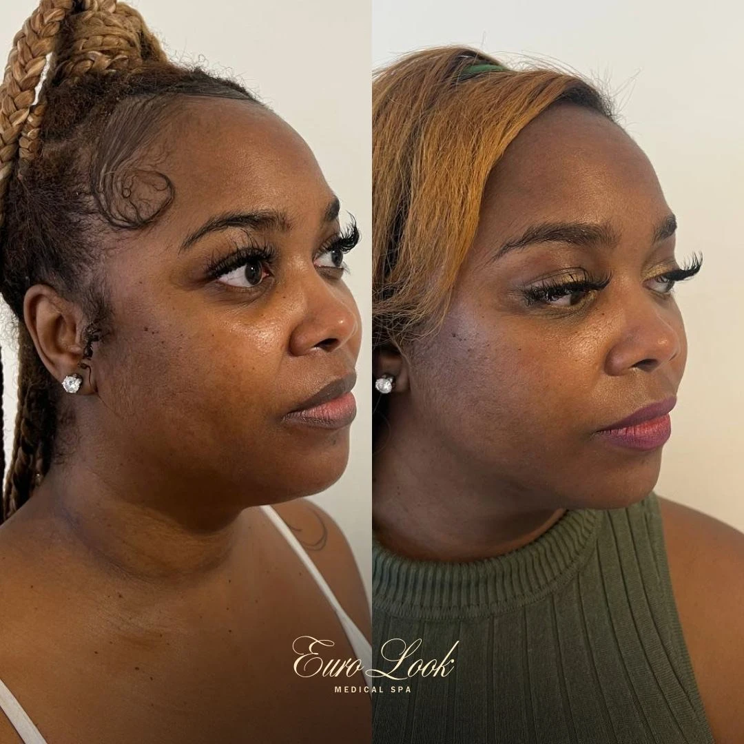 Scarlet RF Microneedling Before and After Results | Euro Look MedSpa
