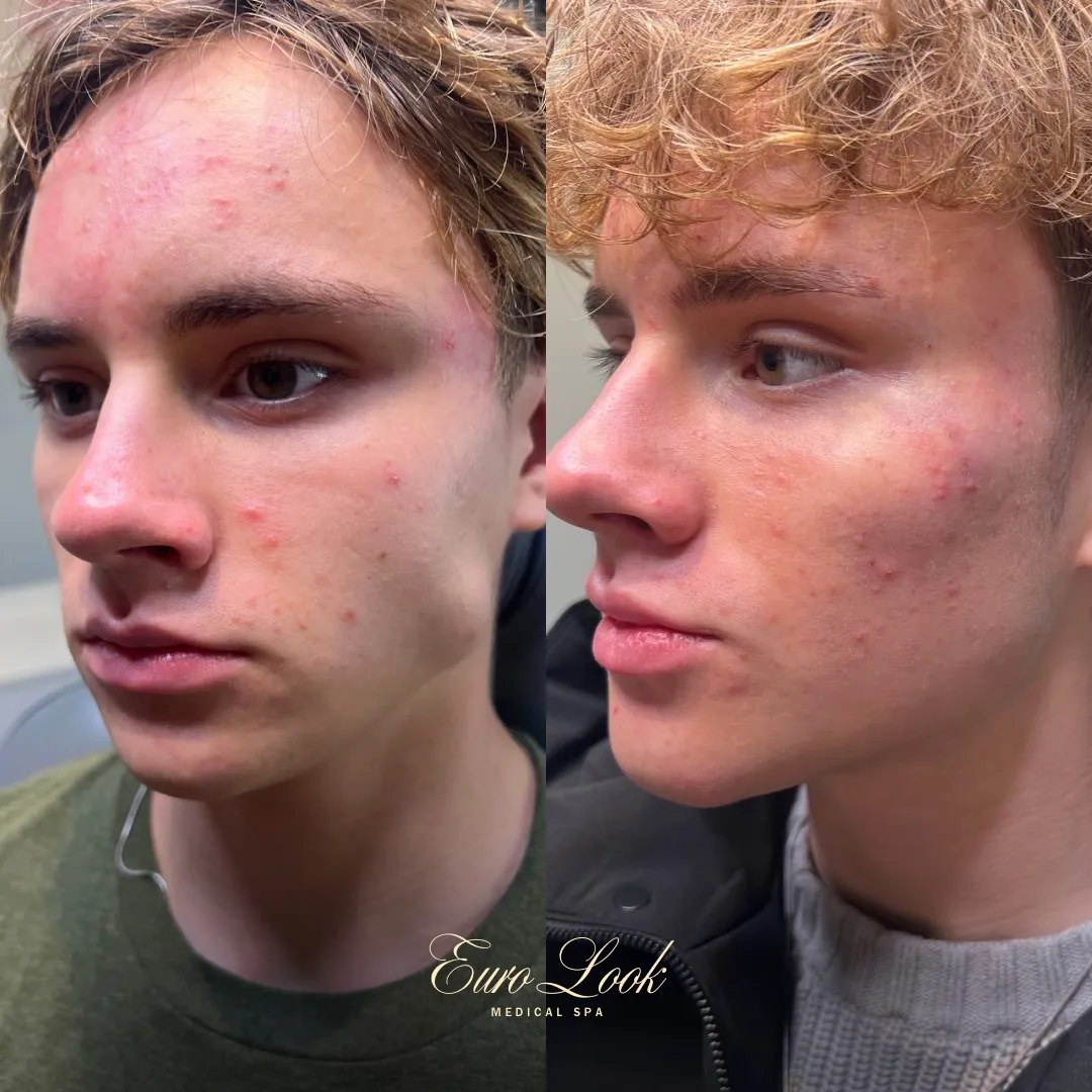 Signature Cheek Filler and Masseter Relaxation Before and After Results | Euro Look MedSpa