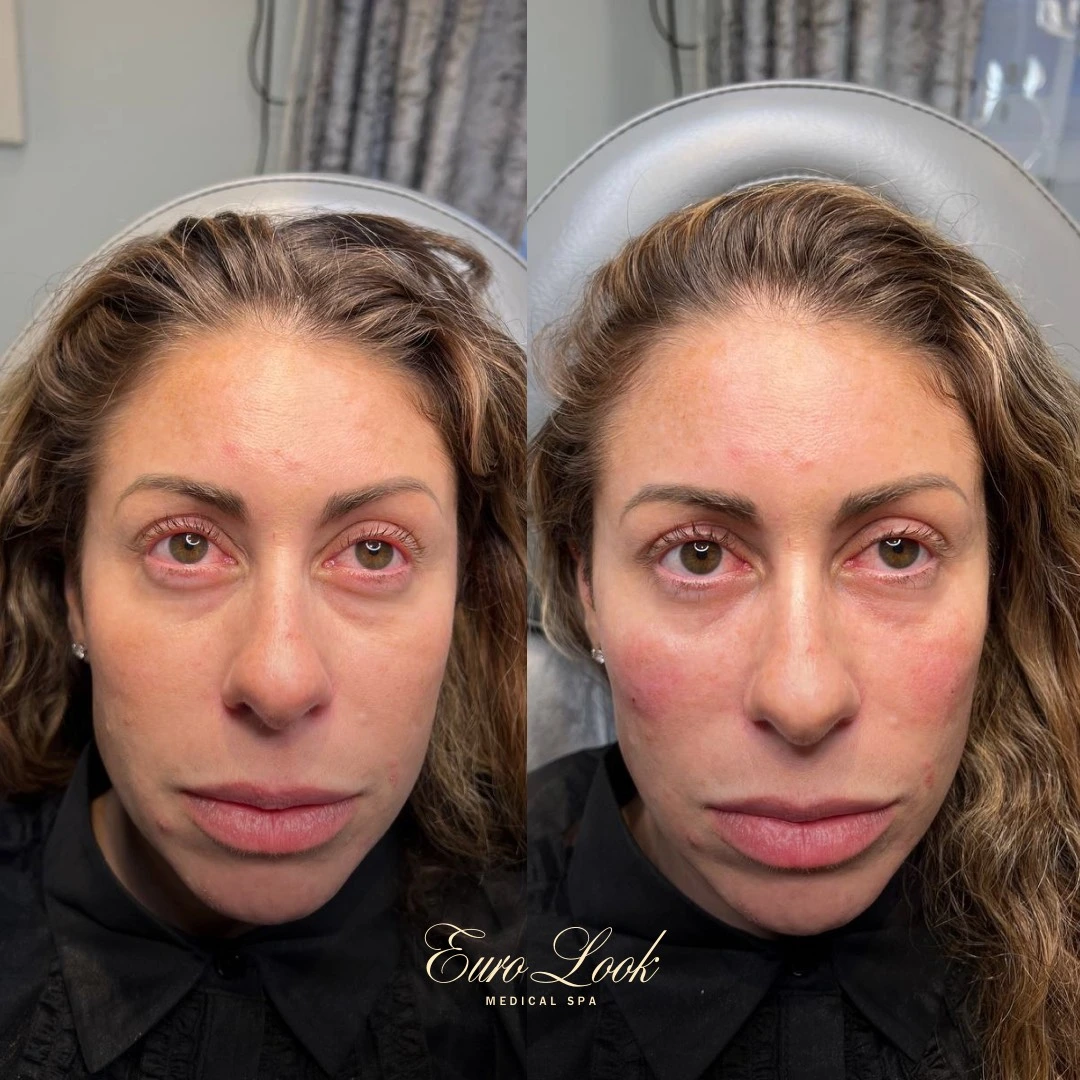 Under Eye Filler Before and After Results | Euro Look MedSpa