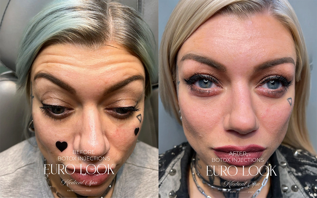 Botox 1