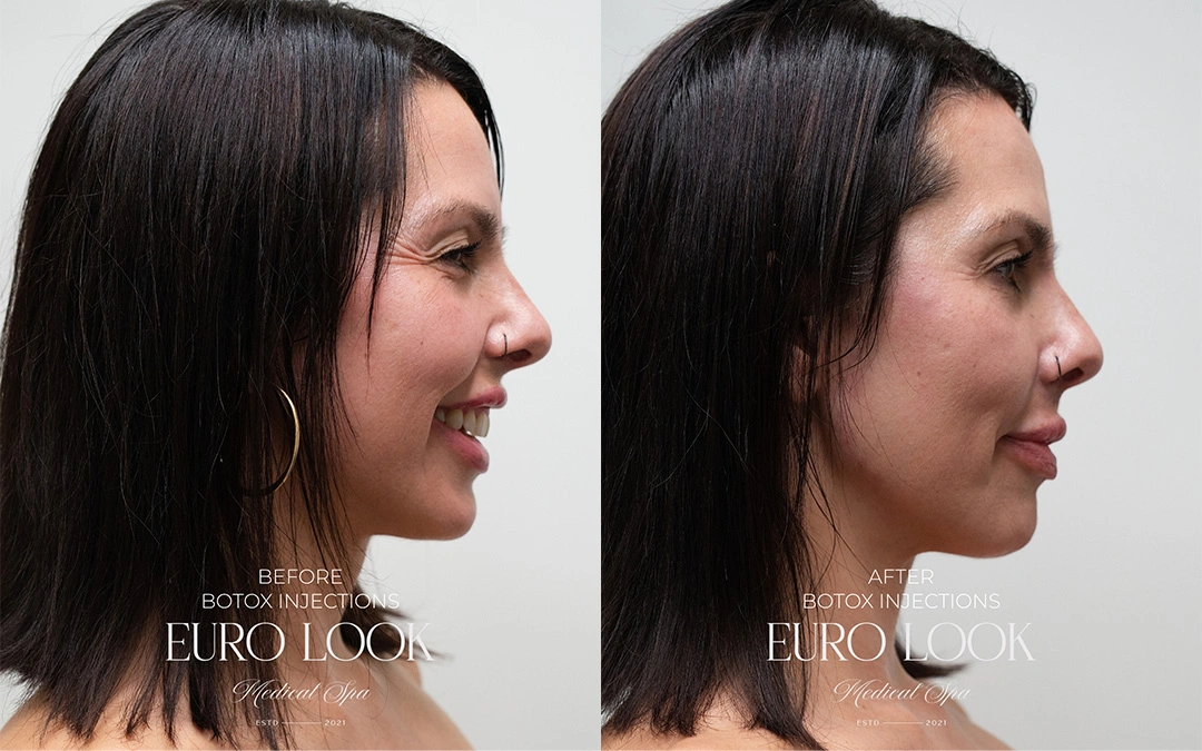Botox 2