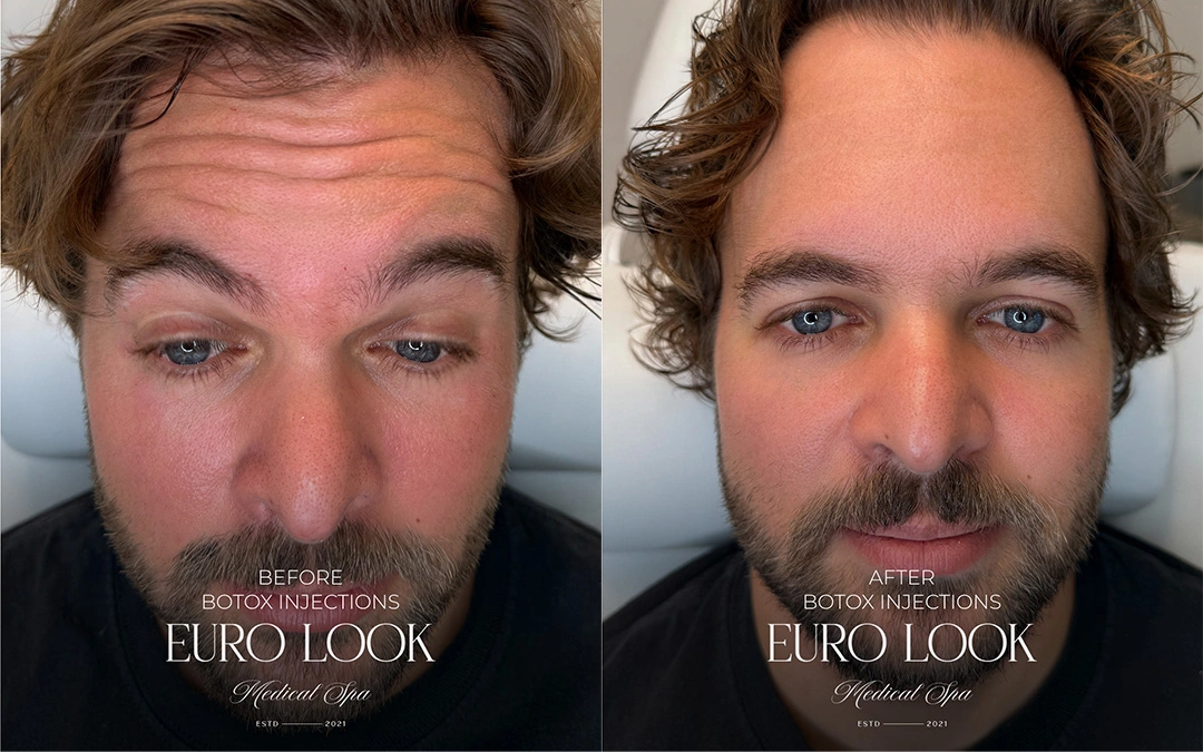 Botox 3