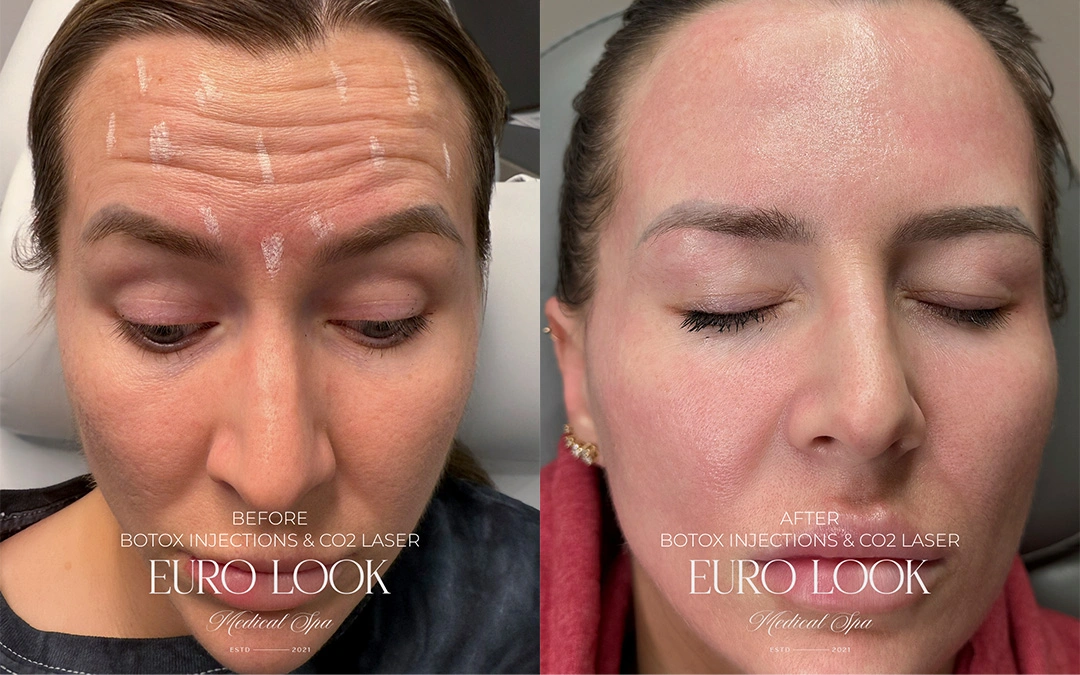 Botox 4