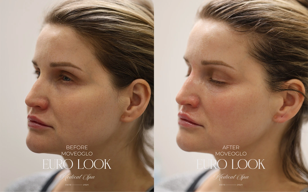 Dermal Fillers 1