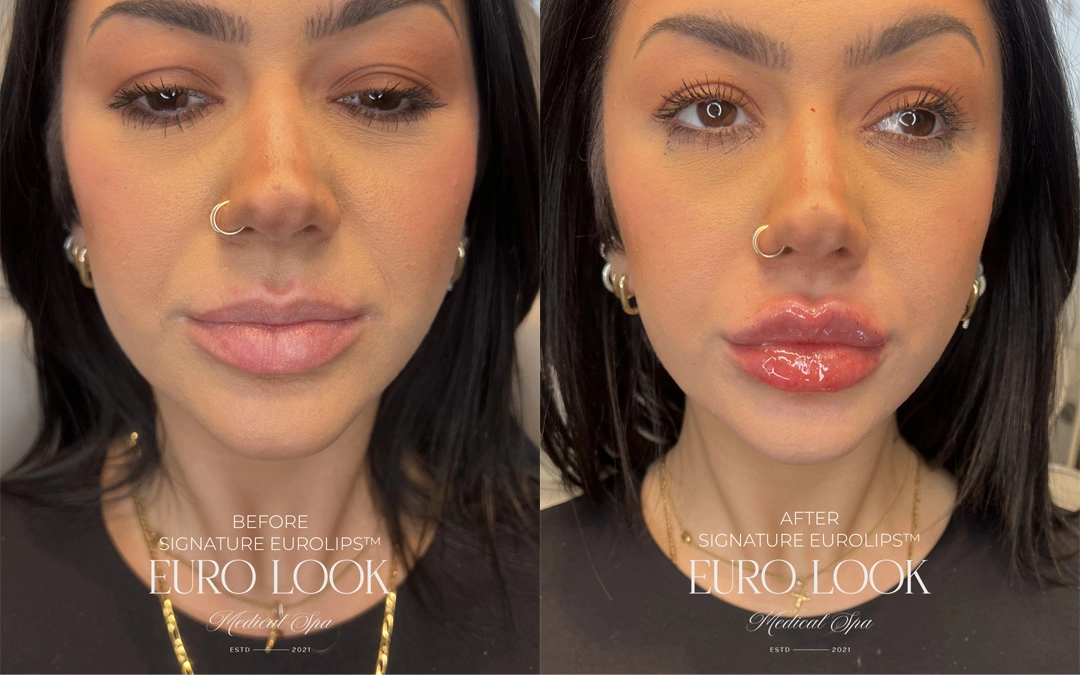Dermal Fillers 10