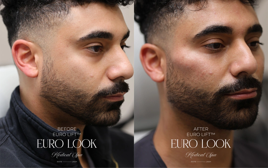 Dermal Fillers 11-2