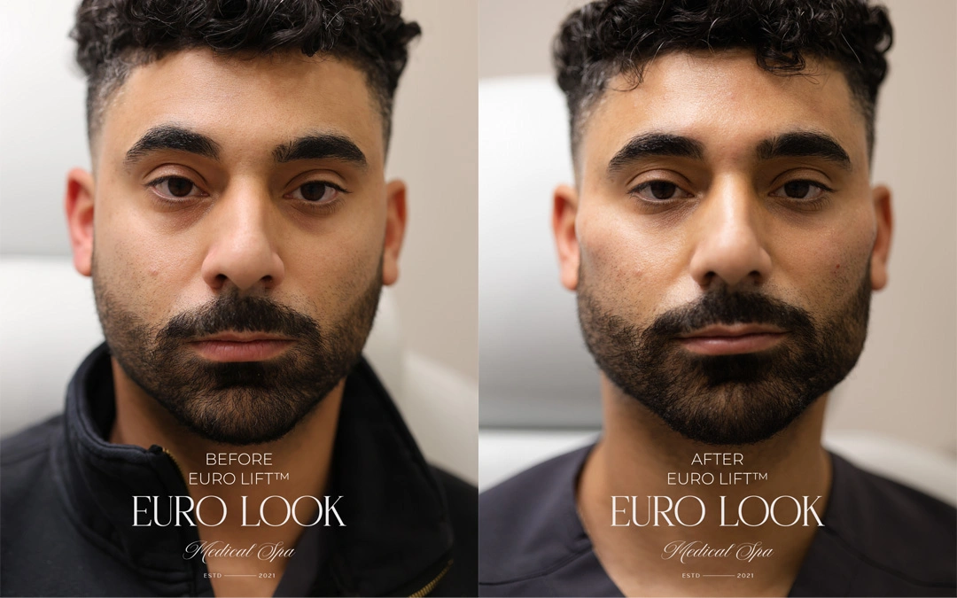 Dermal Fillers 11