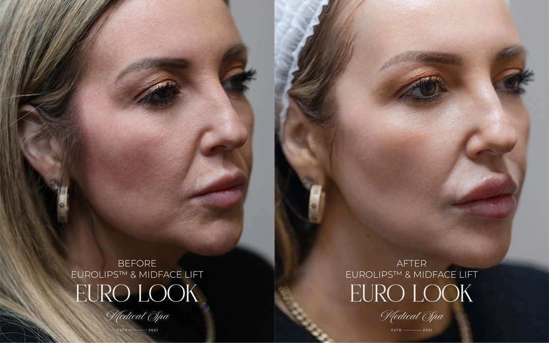 Dermal Fillers 12