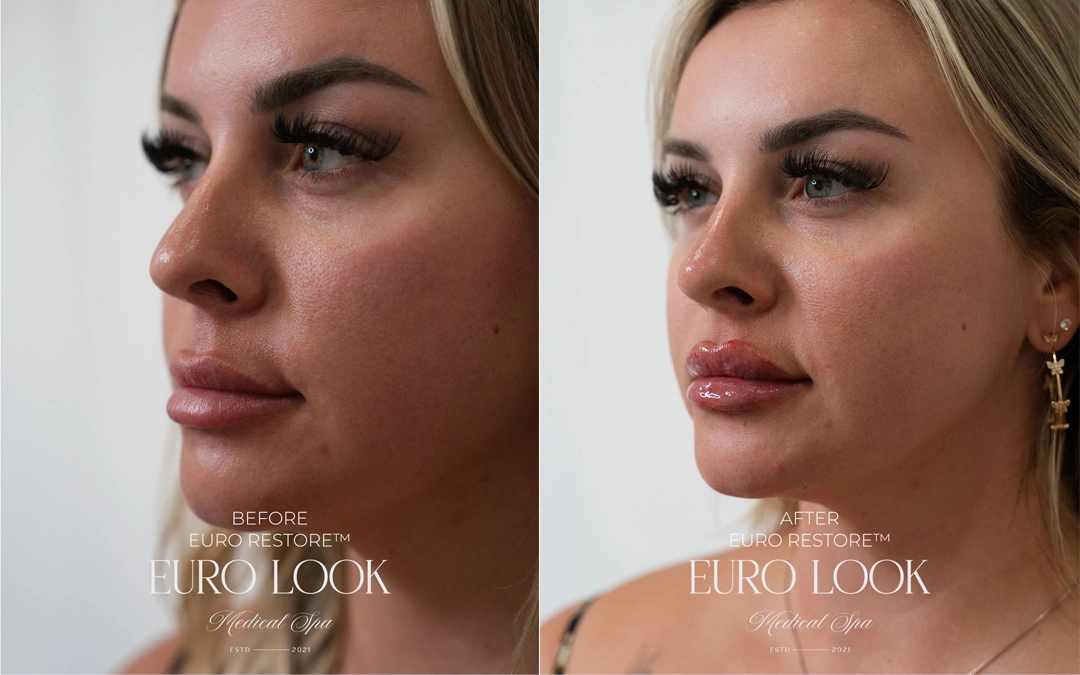 Dermal Fillers 13-2