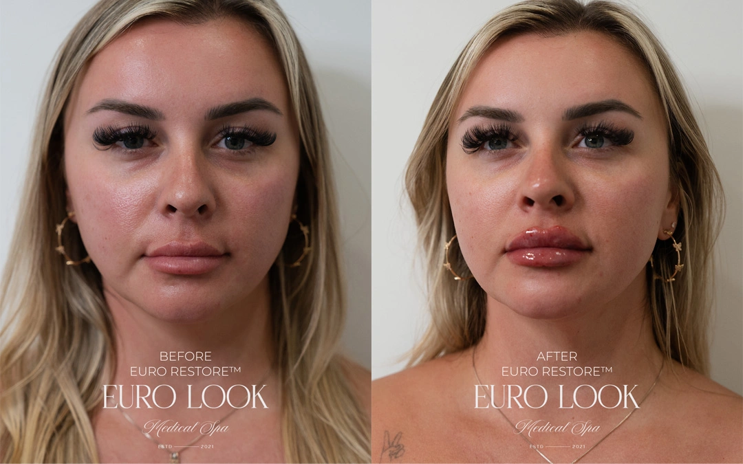 Dermal Fillers 13