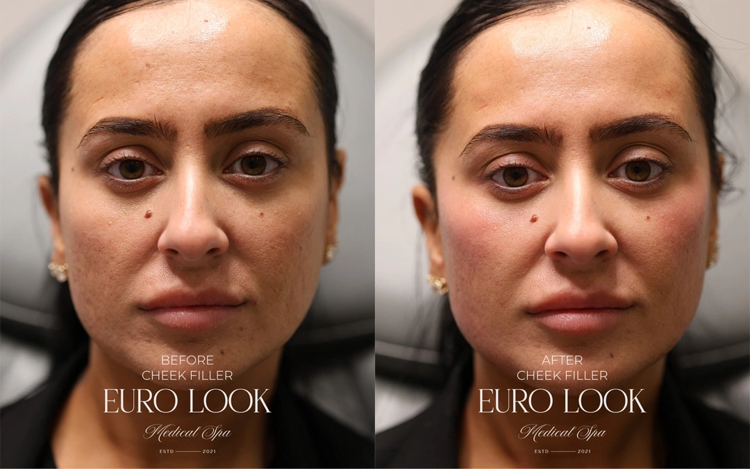 Dermal Fillers 14