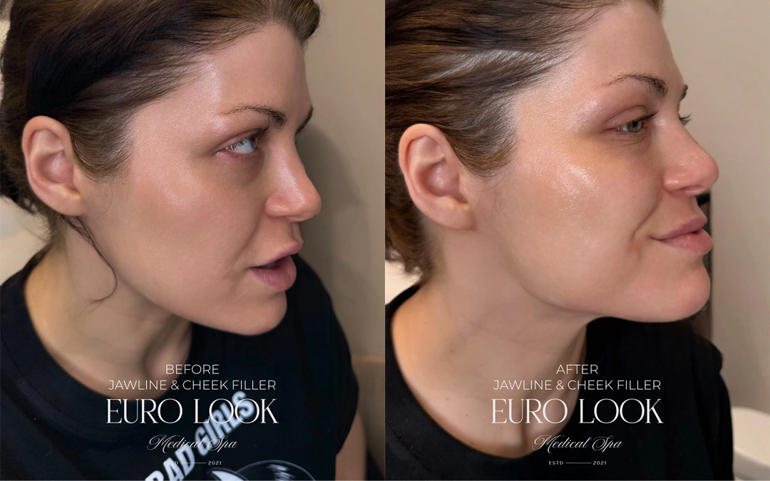 Dermal Fillers 15