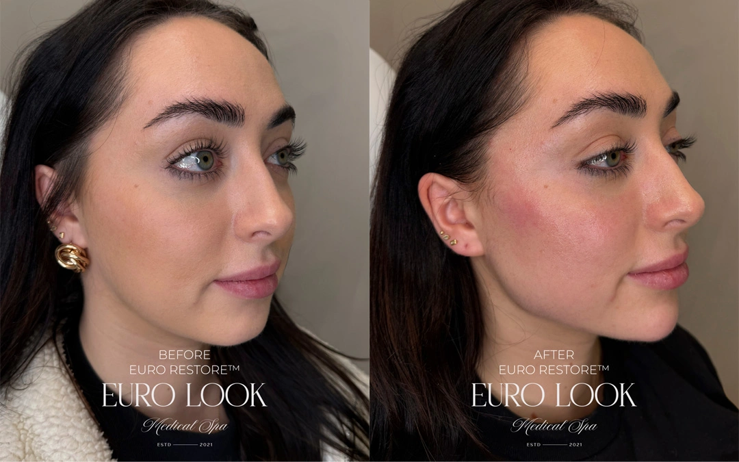 Dermal Fillers 16