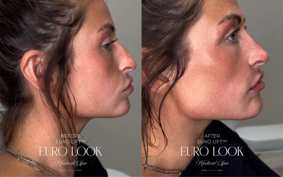 Dermal Fillers 17