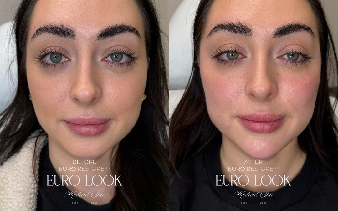 Dermal Fillers 18