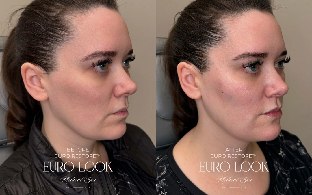 Dermal Fillers 19-2
