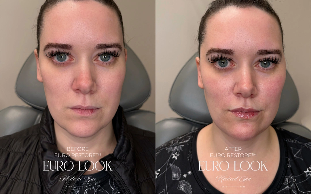 Dermal Fillers 19