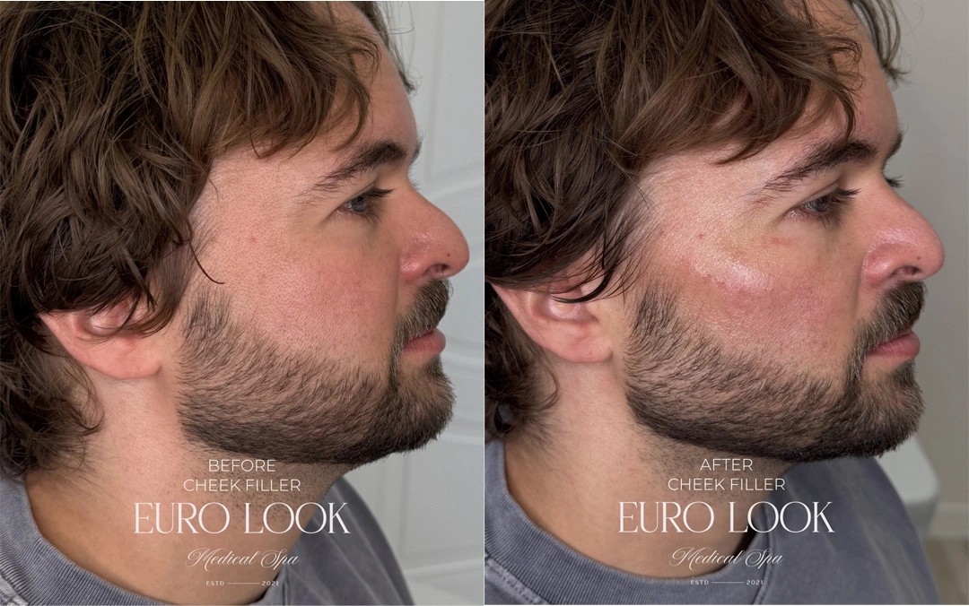 Dermal Fillers 2