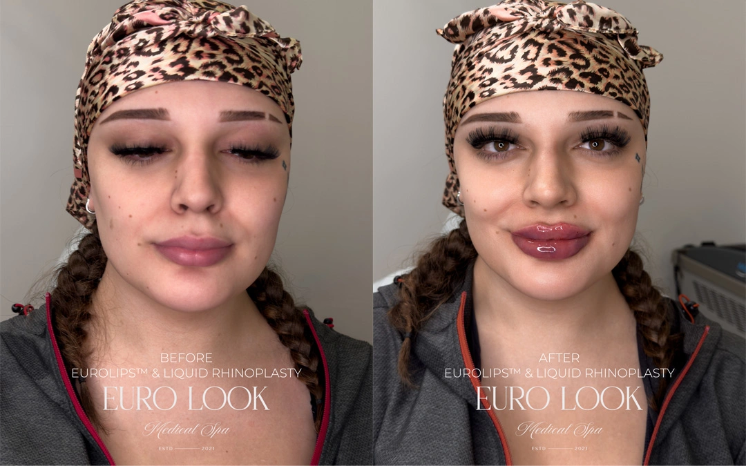 Dermal Fillers 20
