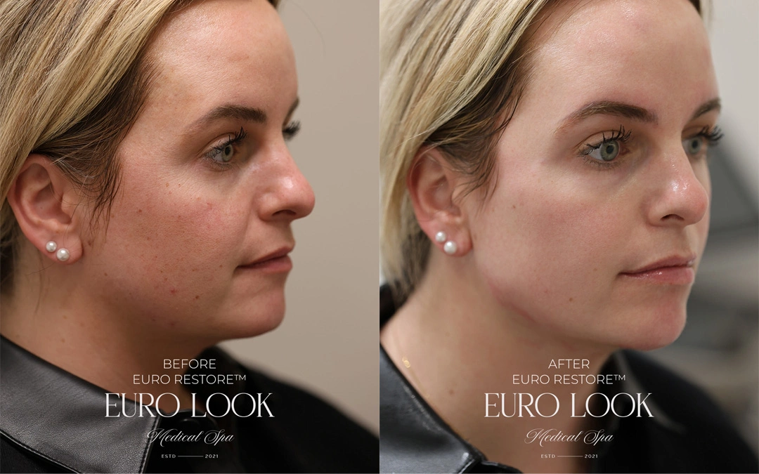 Dermal Fillers 21
