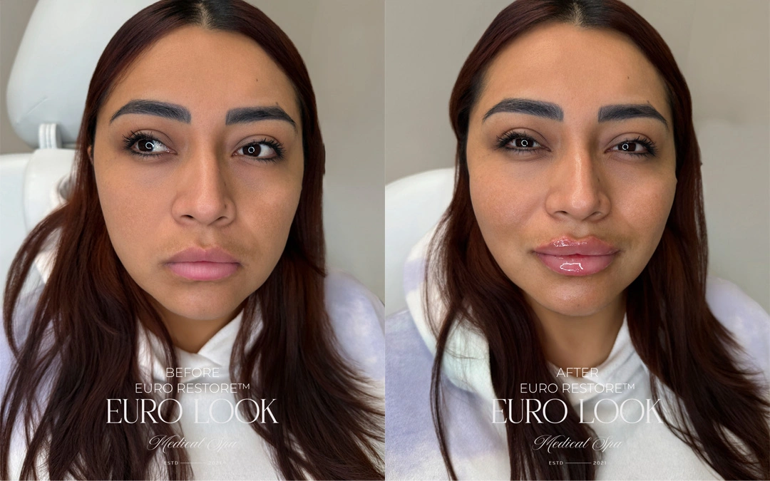 Dermal Fillers 22
