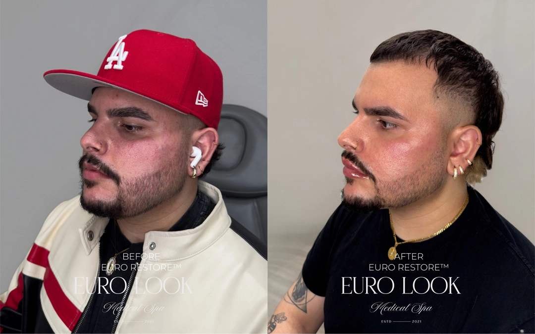 Dermal Fillers 23